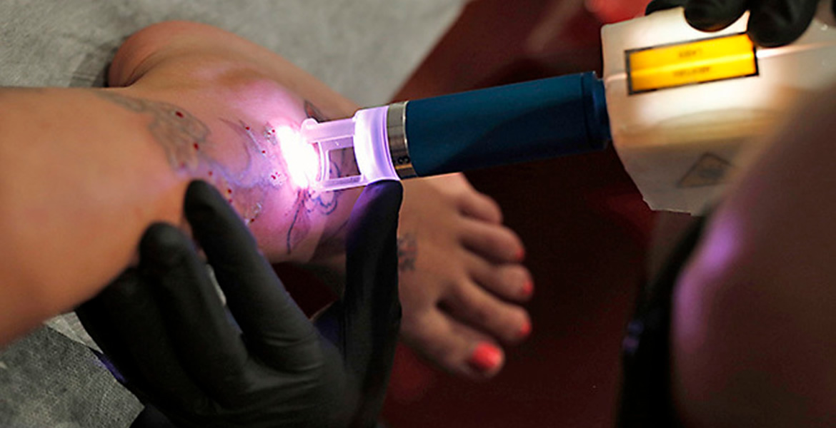 ¿Cómo queda la piel después de borrar un tatuaje con láser?