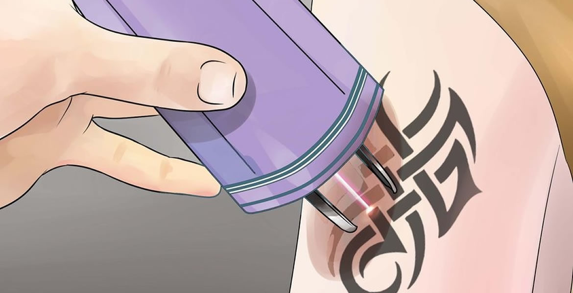 10 cosas a saber antes de borrar un tatuaje con láser