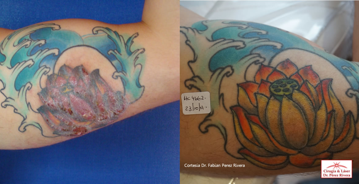 Tatuajes que generan alergia