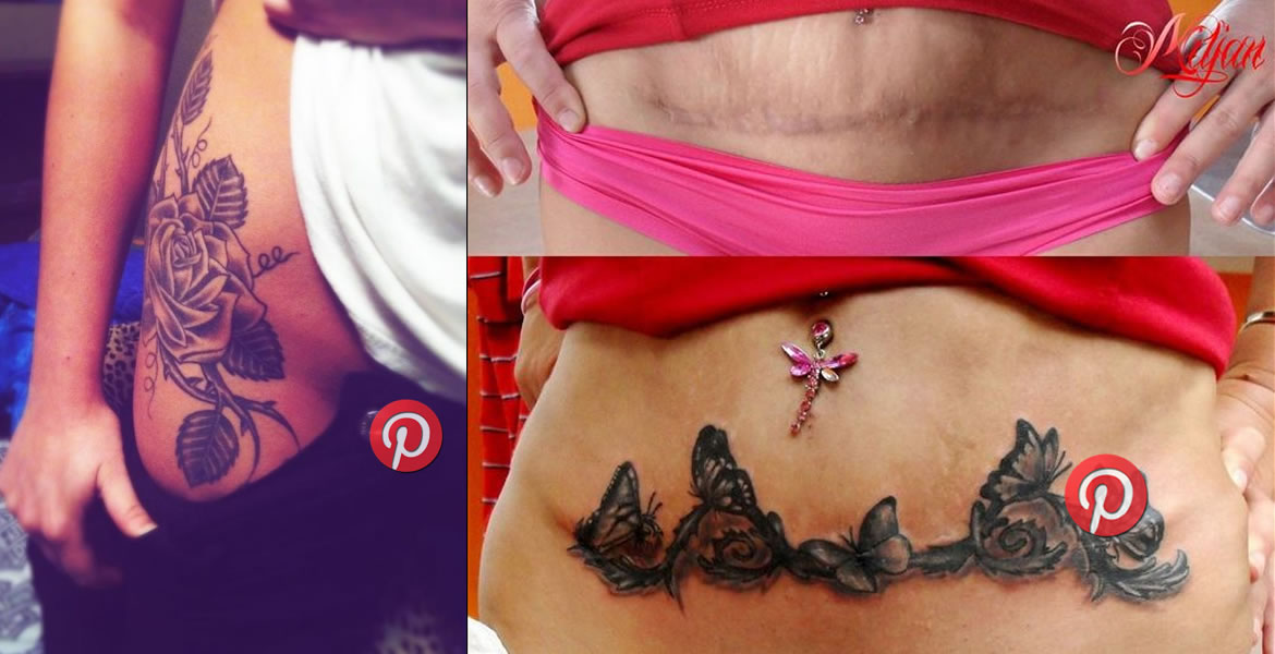 Tatuajes para cubrir estrias y cicatrices